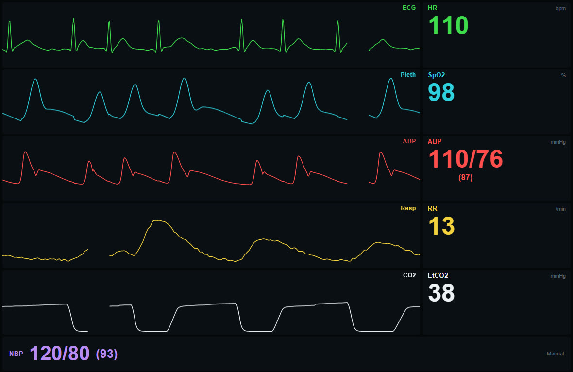 Monitor bei Vorhofflimmern: unregelmäßiges EKG und unterschiedlich hohe Pulswellen in Pleth- und Arterienkurve