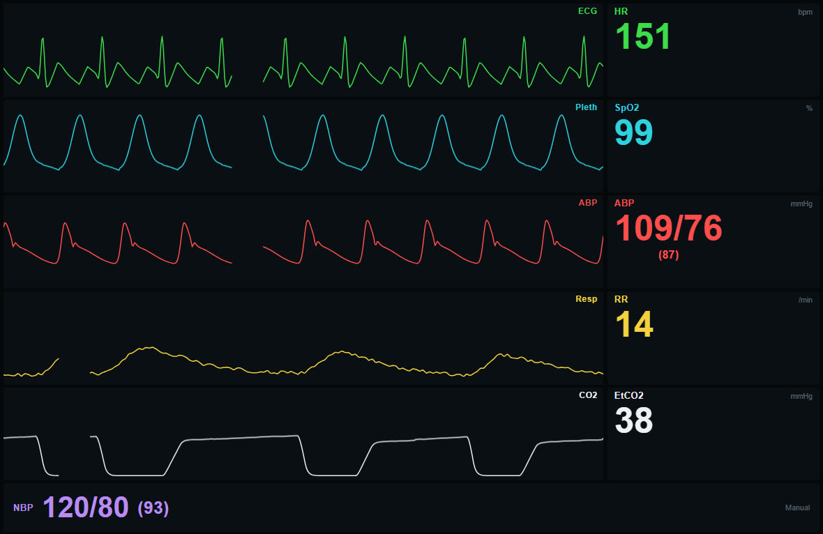 Monitor con flutter auricular con conducción 2:1 y frecuencia cardiaca de 151